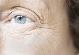 رفع خطوط چروک