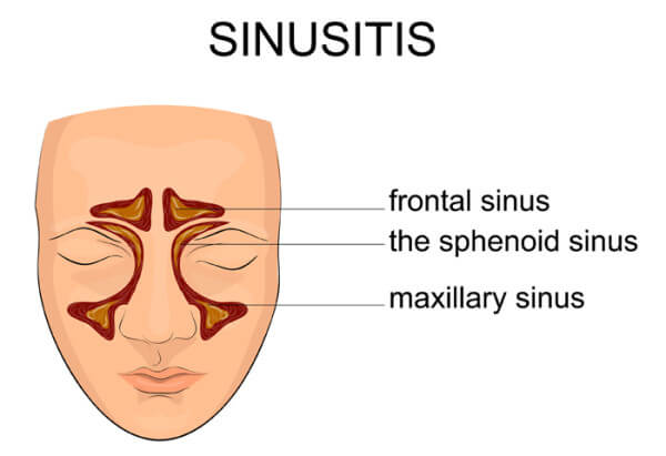 سینوزیت