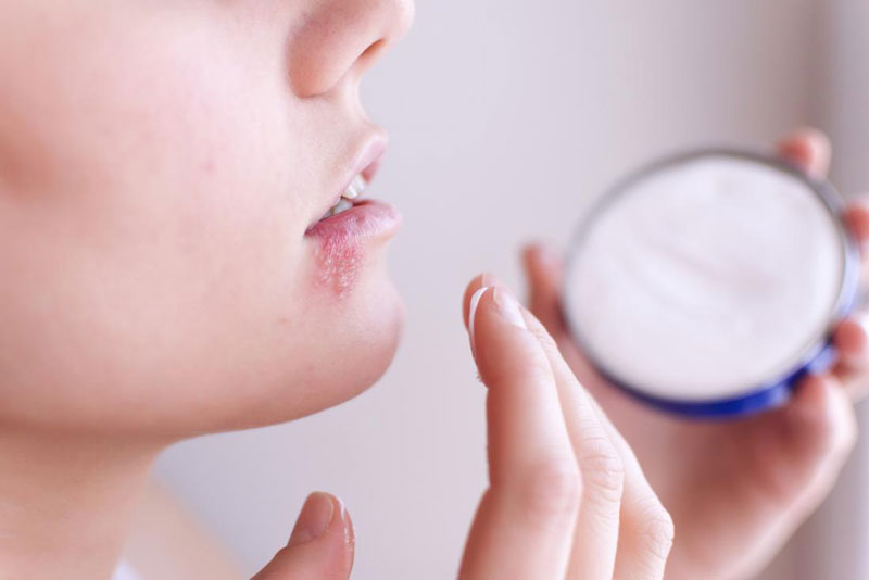 درمان تبخال با لیپس فوراور